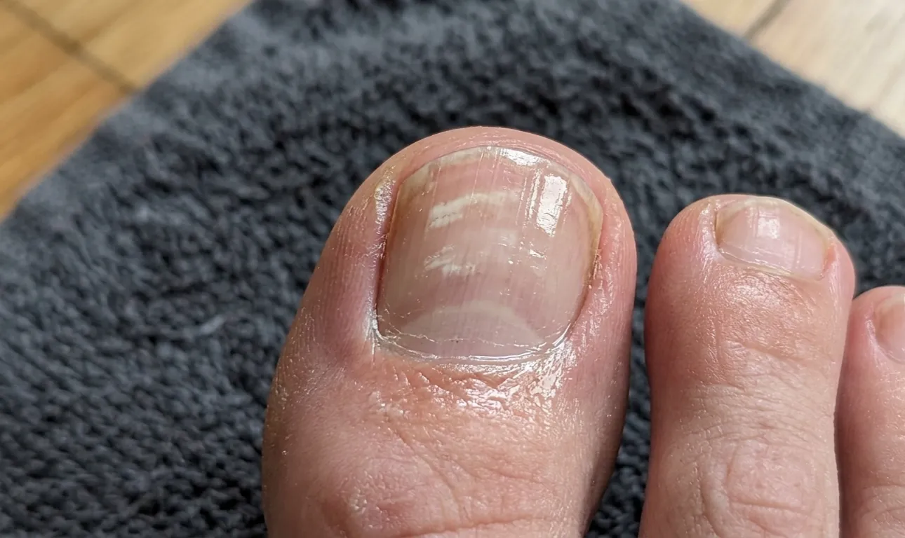 Bílé skvrny na nehtech způsobené těsnými botami zmizí jednoduchou domácí metodou